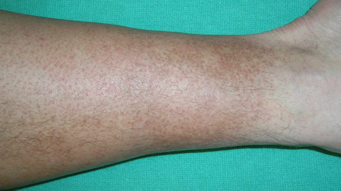 Skin Discoloration