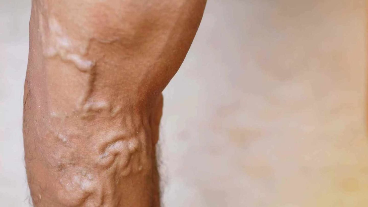 Swollen Veins